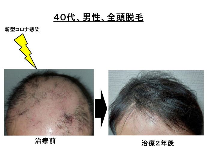 円形脱毛症　病院